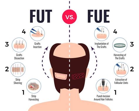 De Verschillen Tussen Haartransplantatie Technieken
