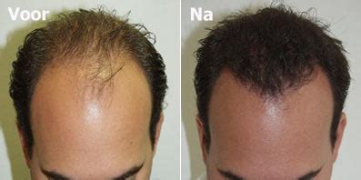 Haartransplantatie En De Rolle Van PRP