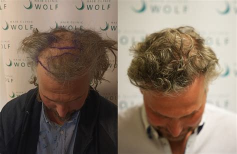 Is Haartransplantatie DHI Geschikt Voor Jou?