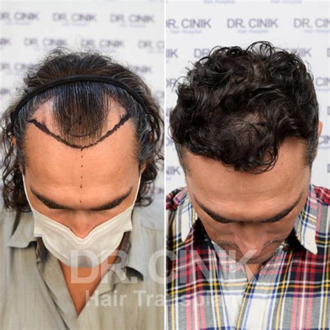 Wat Is Haartransplantatie DHI En Hoe Werkt Het?